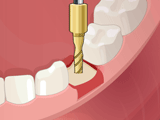 Срочная операция, зубной имплантат